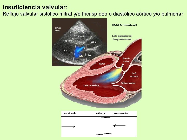 Insuficiencia valvular: Reflujo valvular sistólico mitral y/o tricuspídeo o diastólico aórtico y/o pulmonar http: