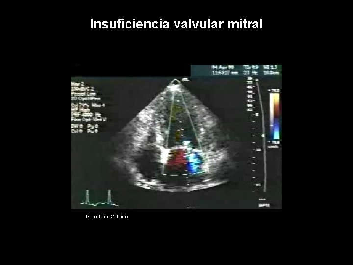 Insuficiencia valvular mitral Dr. Adrián D´Ovidio 