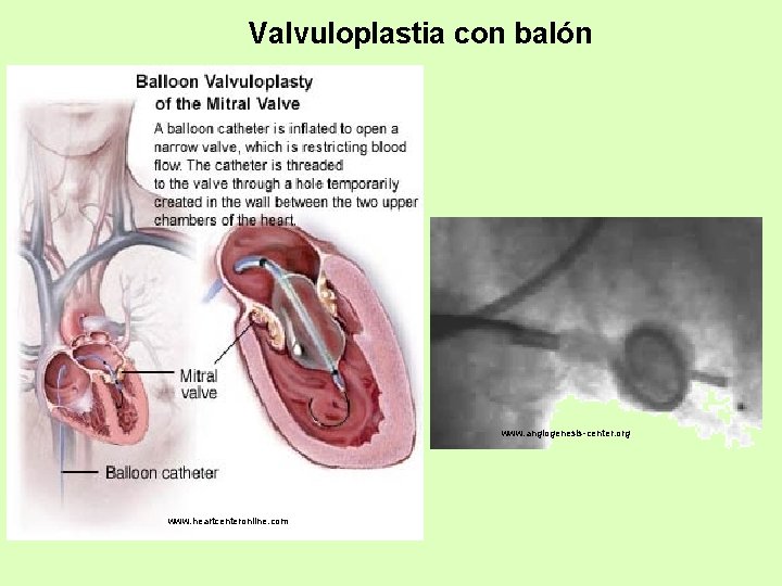 Valvuloplastia con balón www. angiogenesis-center. org www. heartcenteronline. com 