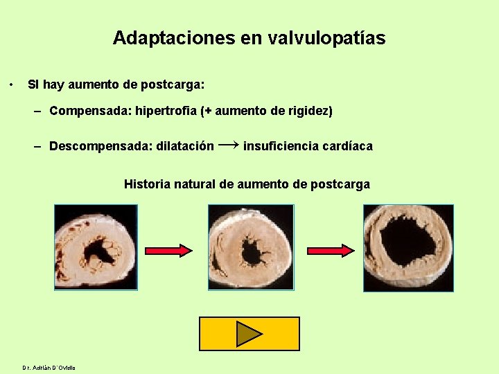 Adaptaciones en valvulopatías • SI hay aumento de postcarga: – Compensada: hipertrofia (+ aumento