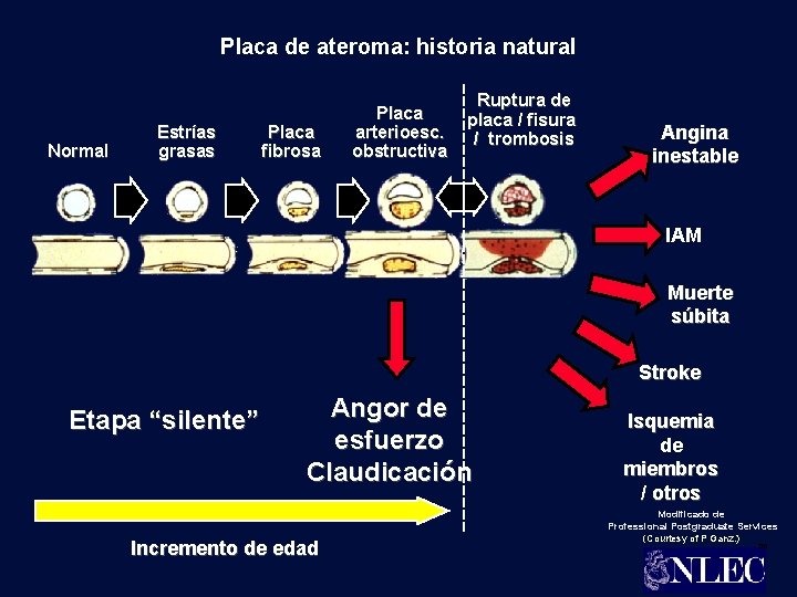 Placa de ateroma: historia natural Normal Estrías grasas Placa fibrosa Placa arterioesc. obstructiva Ruptura