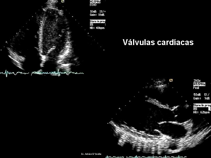 Válvulas cardíacas Dr. Adrián D’Ovidio 