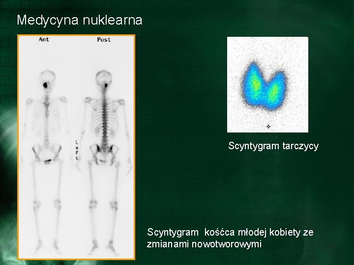 Medycyna nuklearna Scyntygram tarczycy Scyntygram kośćca młodej kobiety ze zmianami nowotworowymi 