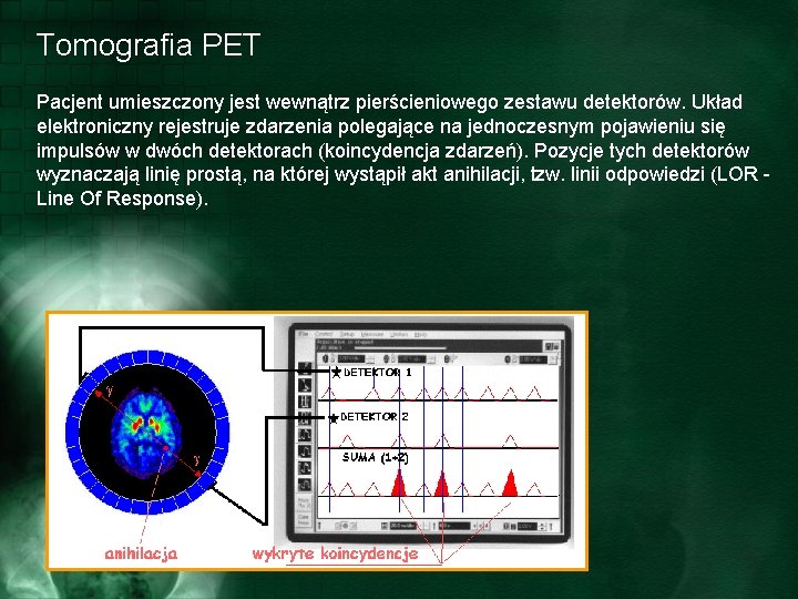Tomografia PET Pacjent umieszczony jest wewnątrz pierścieniowego zestawu detektorów. Układ elektroniczny rejestruje zdarzenia polegające