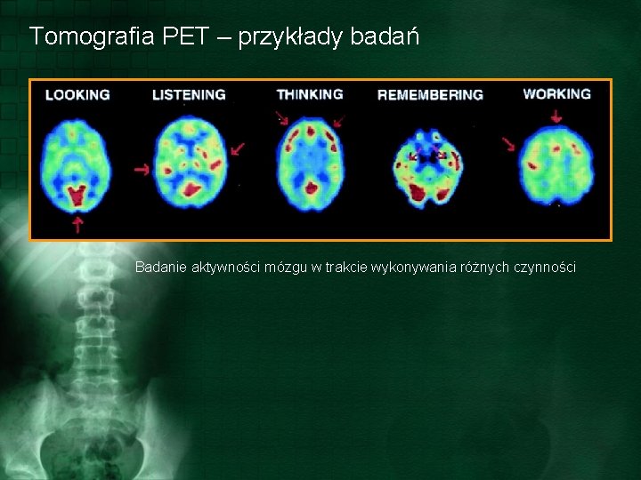 Tomografia PET – przykłady badań Badanie aktywności mózgu w trakcie wykonywania różnych czynności 