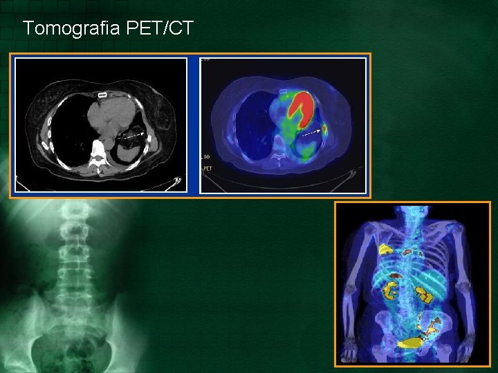 Tomografia PET/CT 