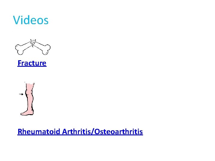 Videos Fracture Rheumatoid Arthritis/Osteoarthritis Videos Fracture Rheumatoid Arthritis/Osteoarthritis