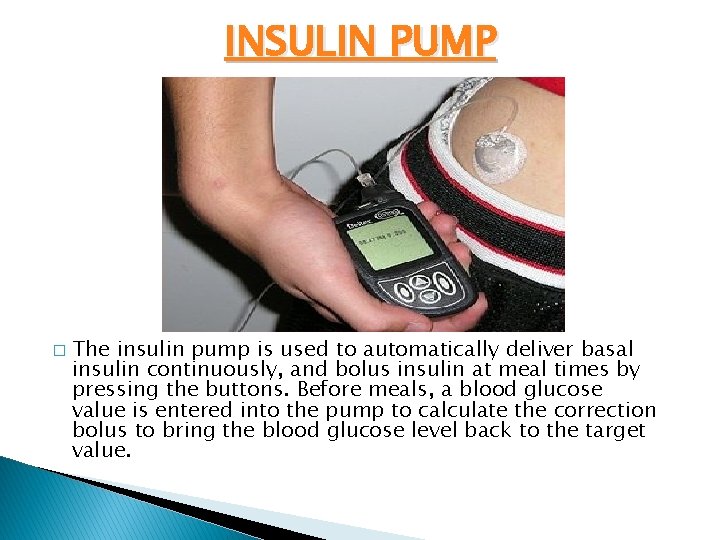 INSULIN PUMP � The insulin pump is used to automatically deliver basal insulin continuously,