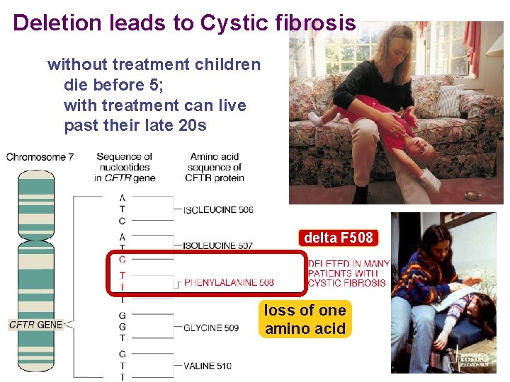 Deletion leads to Cystic fibrosis without treatment children die before 5; with treatment can