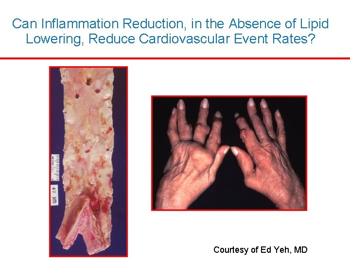 Can Inflammation Reduction, in the Absence of Lipid Lowering, Reduce Cardiovascular Event Rates? Courtesy