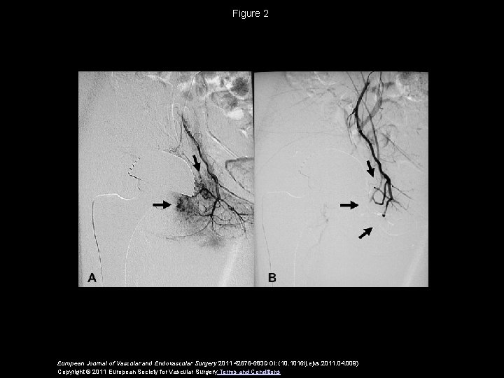 Figure 2 European Journal of Vascular and Endovascular Surgery 2011 42676 -683 DOI: (10.