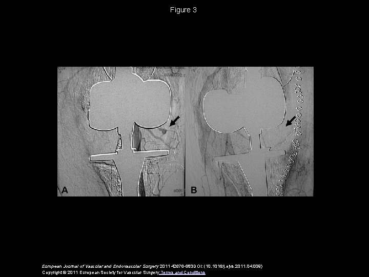 Figure 3 European Journal of Vascular and Endovascular Surgery 2011 42676 -683 DOI: (10.