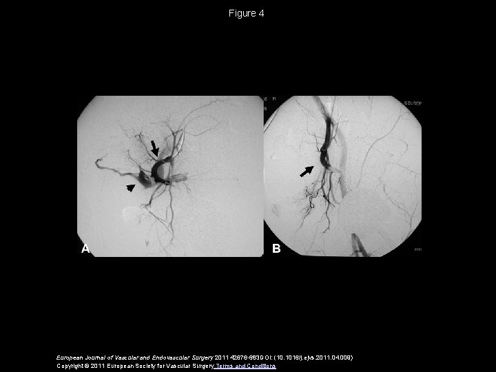 Figure 4 European Journal of Vascular and Endovascular Surgery 2011 42676 -683 DOI: (10.