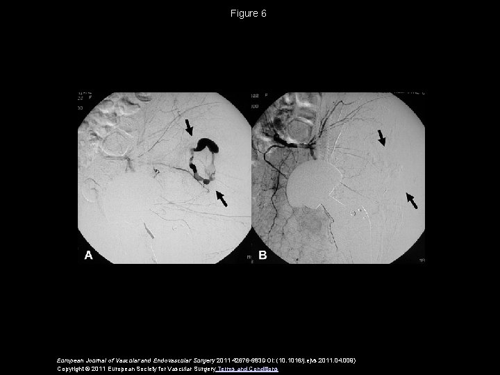 Figure 6 European Journal of Vascular and Endovascular Surgery 2011 42676 -683 DOI: (10.