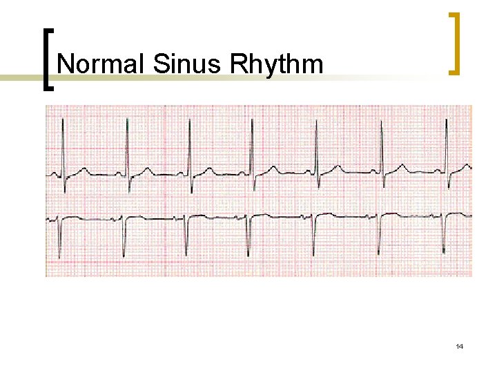 Normal Sinus Rhythm 14 