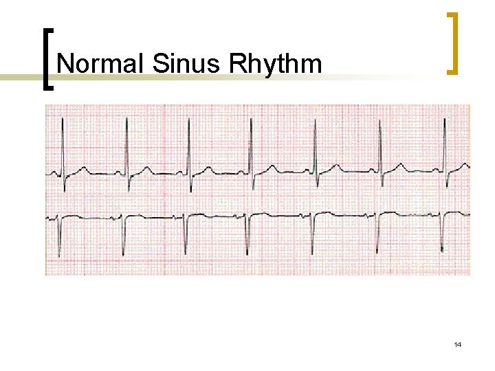 Normal Sinus Rhythm 14 Normal Sinus Rhythm 14
