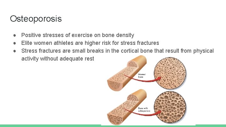 Osteoporosis ● Positive stresses of exercise on bone density ● Elite women athletes are