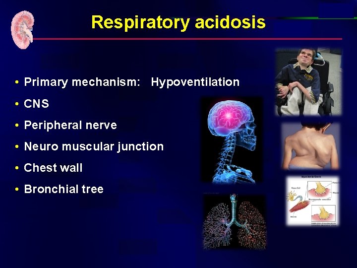 Respiratory acidosis • Primary mechanism: Hypoventilation • CNS • Peripheral nerve • Neuro muscular