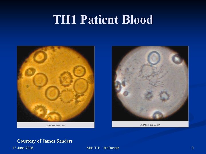 TH 1 Patient Blood Courtesy of James Sanders 17 June 2006 Aids TH 1