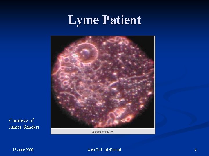 Lyme Patient Courtesy of James Sanders 17 June 2006 Aids TH 1 - Mc.