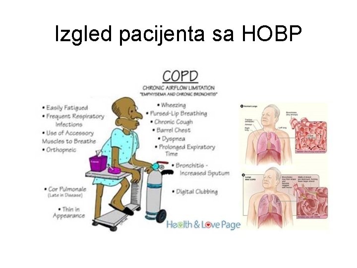Izgled pacijenta sa HOBP 