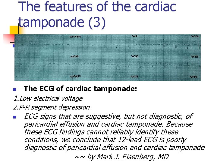 The features of the cardiac tamponade (3) The ECG of cardiac tamponade: 1. Low
