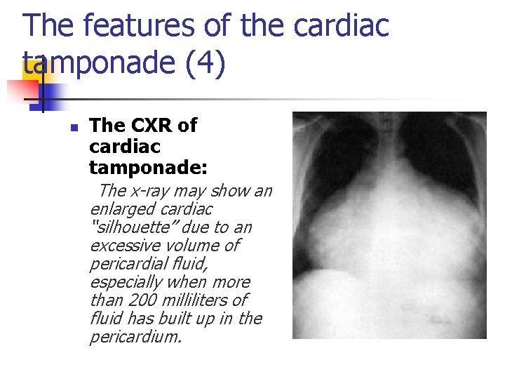 The features of the cardiac tamponade (4) n The CXR of cardiac tamponade: The