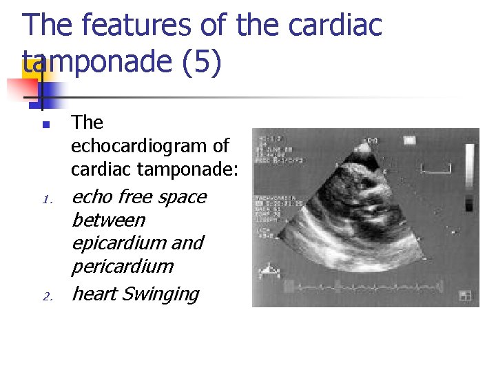 The features of the cardiac tamponade (5) n 1. 2. The echocardiogram of cardiac