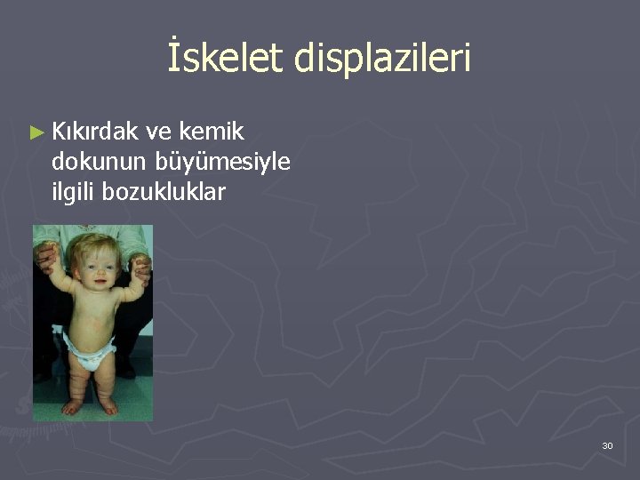 İskelet displazileri ► Kıkırdak ve kemik dokunun büyümesiyle ilgili bozukluklar 30 