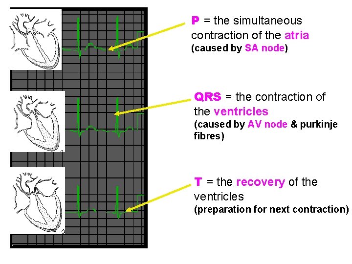 P = the simultaneous contraction of the atria (caused by SA node) QRS =