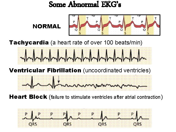Some Abnormal EKG’s NORMAL Tachycardia (a heart rate of over 100 beats/min) Ventricular Fibrillation