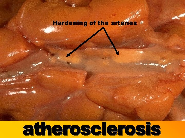 Hardening of the arteries 