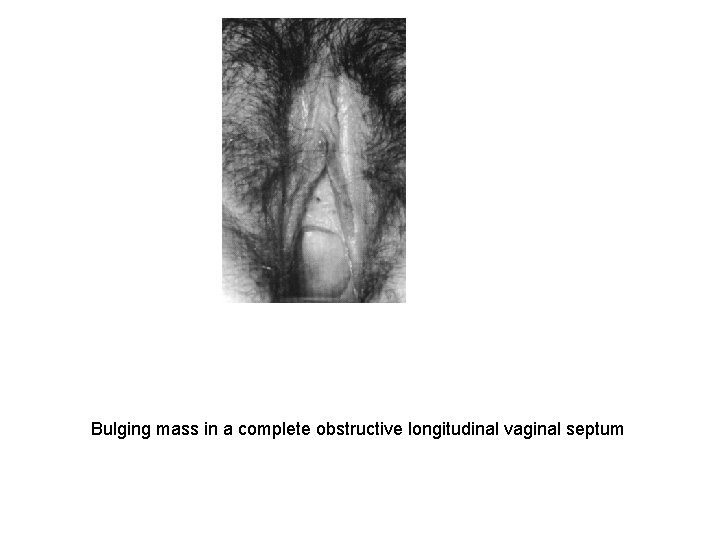 Bulging mass in a complete obstructive longitudinal vaginal septum 