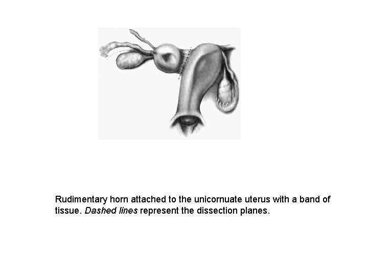 Rudimentary horn attached to the unicornuate uterus with a band of tissue. Dashed lines