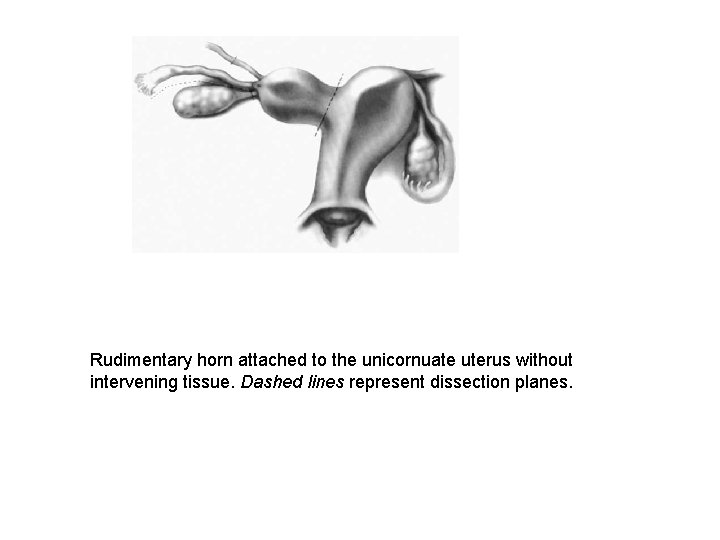 Rudimentary horn attached to the unicornuate uterus without intervening tissue. Dashed lines represent dissection