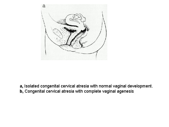 a, Isolated congenital cervical atresia with normal vaginal development. b, Congenital cervical atresia with