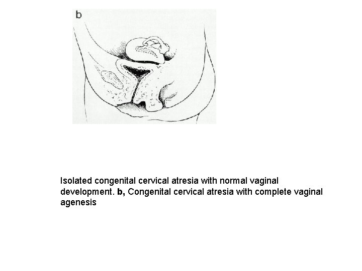 Isolated congenital cervical atresia with normal vaginal development. b, Congenital cervical atresia with complete