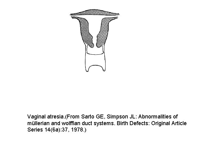 Vaginal atresia. (From Sarto GE, Simpson JL: Abnormalities of müllerian and wolffian duct systems.