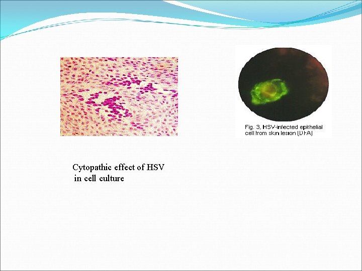 Cytopathic effect of HSV in cell culture 