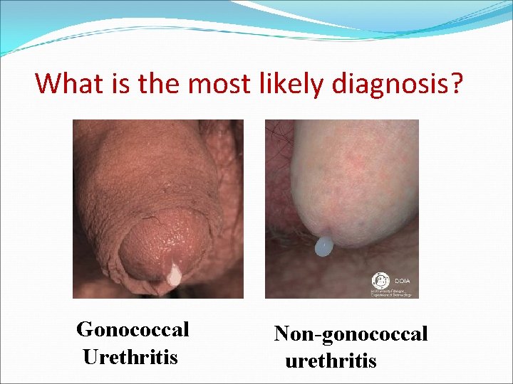 What is the most likely diagnosis? Gonococcal Urethritis Non-gonococcal urethritis 