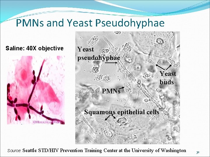 PMNs and Yeast Pseudohyphae Saline: 40 X objective Yeast pseudohyphae Yeast buds PMNs Squamous