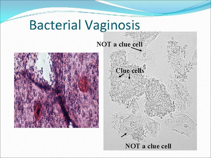 Bacterial Vaginosis NOT a clue cell Clue cells NOT a clue cell 