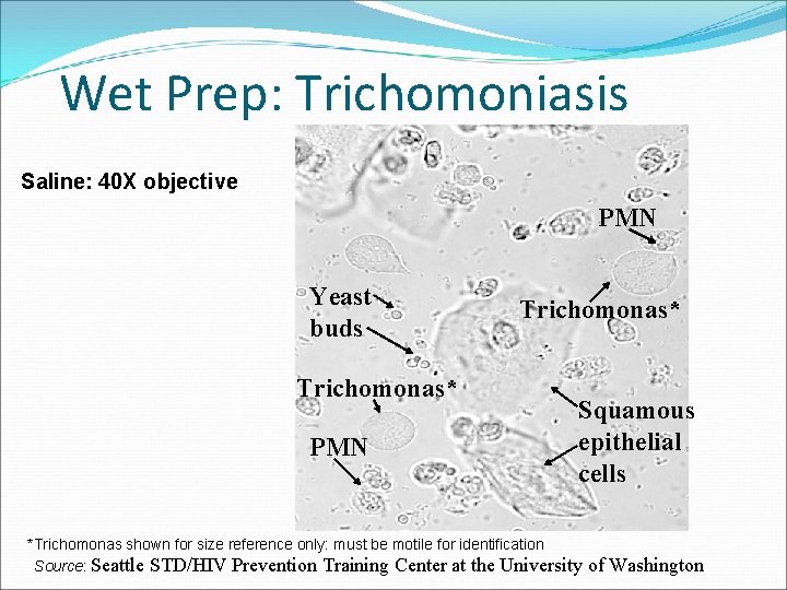 Wet Prep: Trichomoniasis Saline: 40 X objective PMN Yeast buds Trichomonas* PMN Trichomonas* Squamous