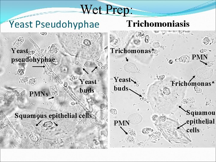 Wet Prep: Yeast Pseudohyphae Trichomonas* Yeast pseudohyphae PMNs Trichomoniasis Yeast buds Squamous epithelial cells