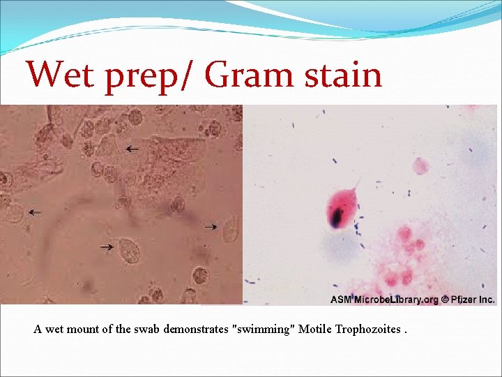Wet prep/ Gram stain A wet mount of the swab demonstrates "swimming" Motile Trophozoites.