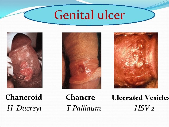 Genital ulcer Chancroid H Ducreyi Chancre T Pallidum Ulcerated Vesicles HSV 2 