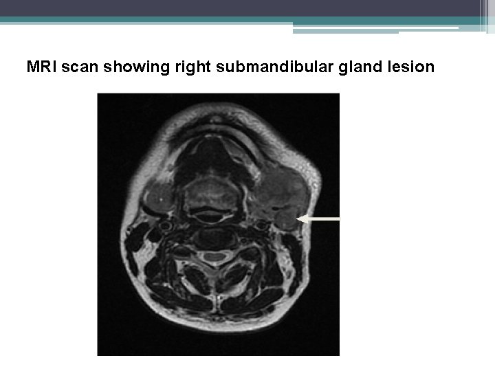 MRI scan showing right submandibular gland lesion 