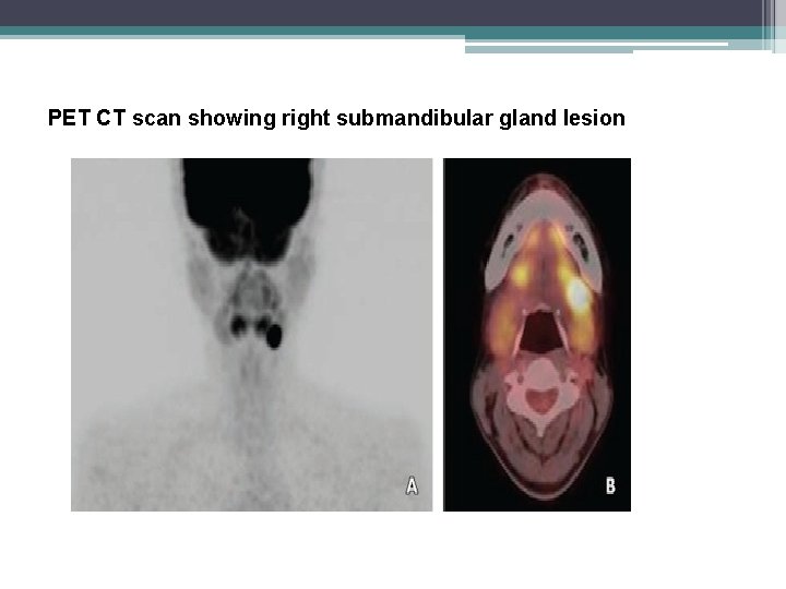 PET CT scan showing right submandibular gland lesion 