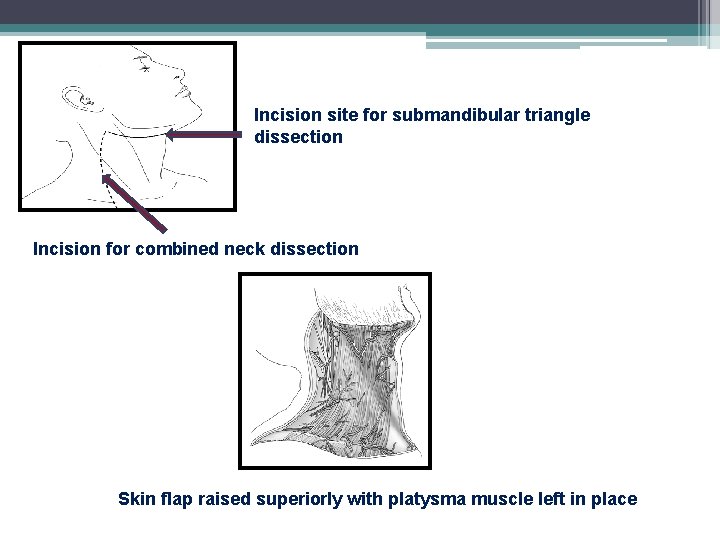 Incision site for submandibular triangle dissection Incision for combined neck dissection Skin flap raised