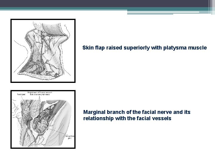 Skin flap raised superiorly with platysma muscle Marginal branch of the facial nerve and